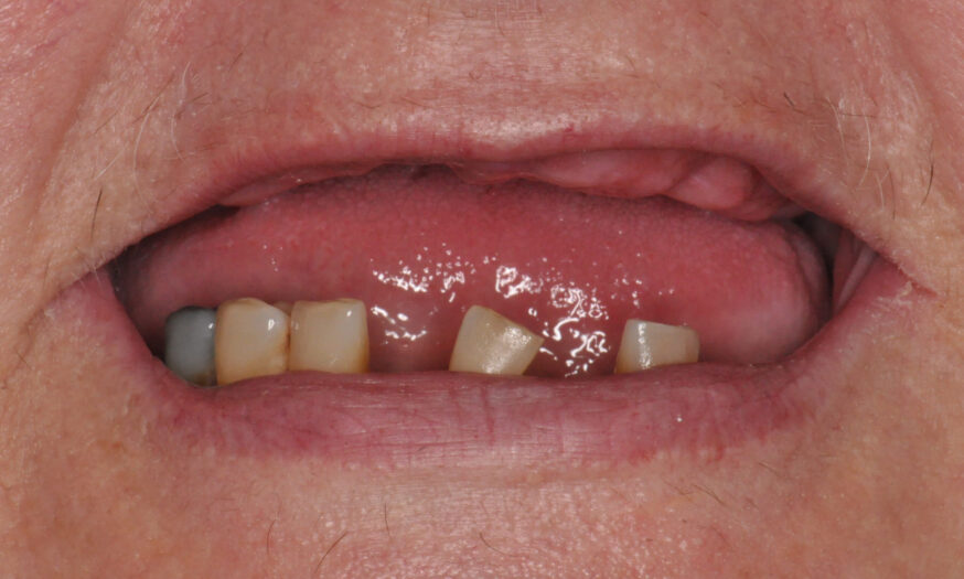 DSC_0011 Before - NB Dental