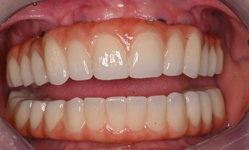 DSC_2590 After - NB Dental